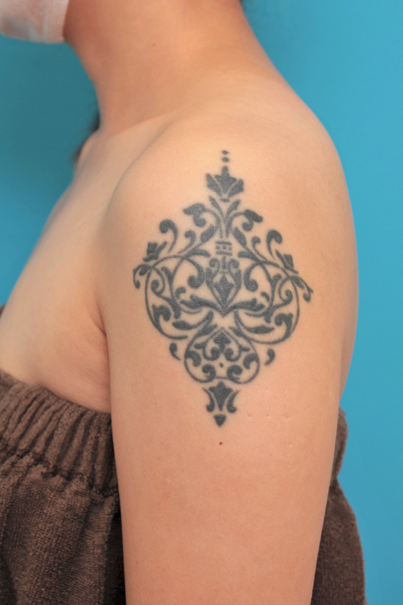 刺青（タトゥー）除去,肩の大きな入れ墨を2回に分けて切除縫縮した症例写真,Before,ba_irezumi038_b01.jpg