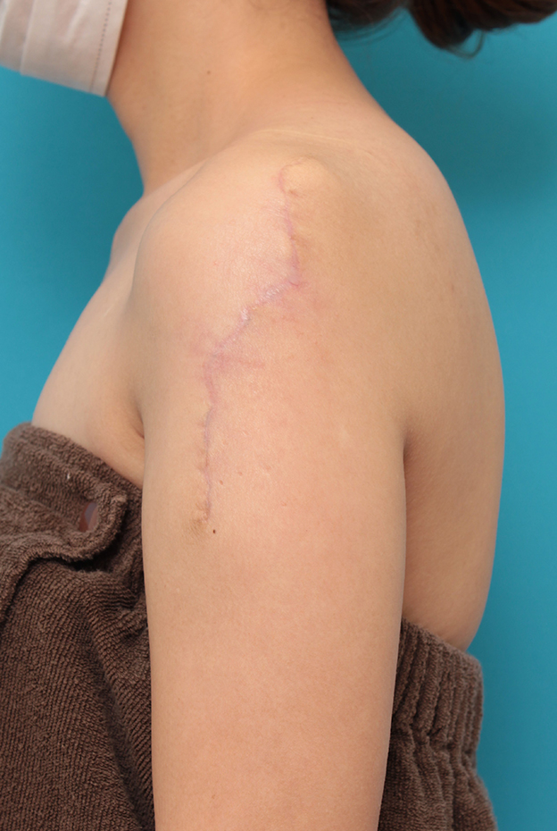 刺青（タトゥー）除去,肩の大きな入れ墨を2回に分けて切除縫縮した症例写真,2回目手術後3ヶ月,mainpic_irezumi038i.jpg