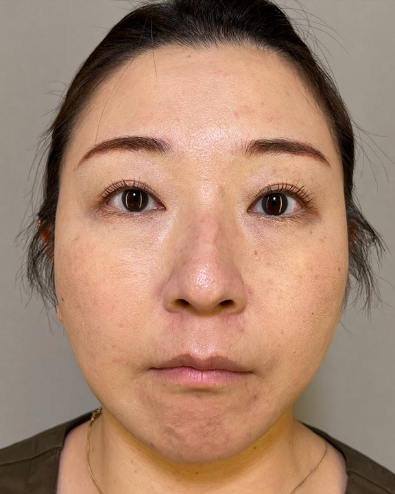 ミニフェイスリフト（頬のたるみ取り）,ミニフェイスリフトで口元のたるみを改善した女性の症例写真,After（3ヶ月後）,ba_minilift016_b01.jpg