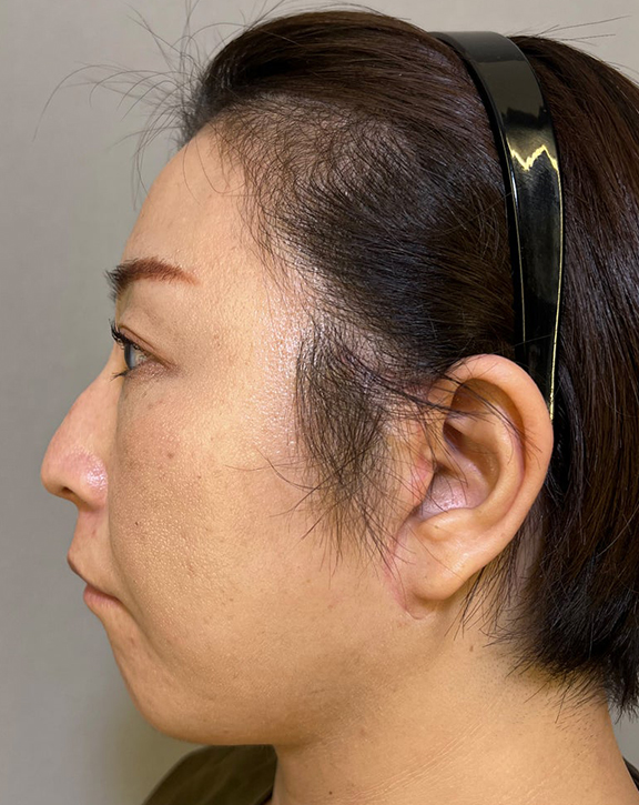 ミニフェイスリフト（頬のたるみ取り）,ミニフェイスリフトで口元のたるみを改善した女性の症例写真,After（3ヶ月後）,ba_minilift016_b02.jpg