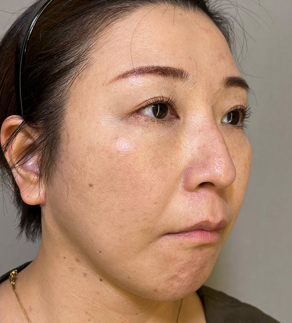 ミニフェイスリフト（頬のたるみ取り）,ミニフェイスリフトで口元のたるみを改善した女性の症例写真,After（3ヶ月後）,ba_minilift016_b03.jpg