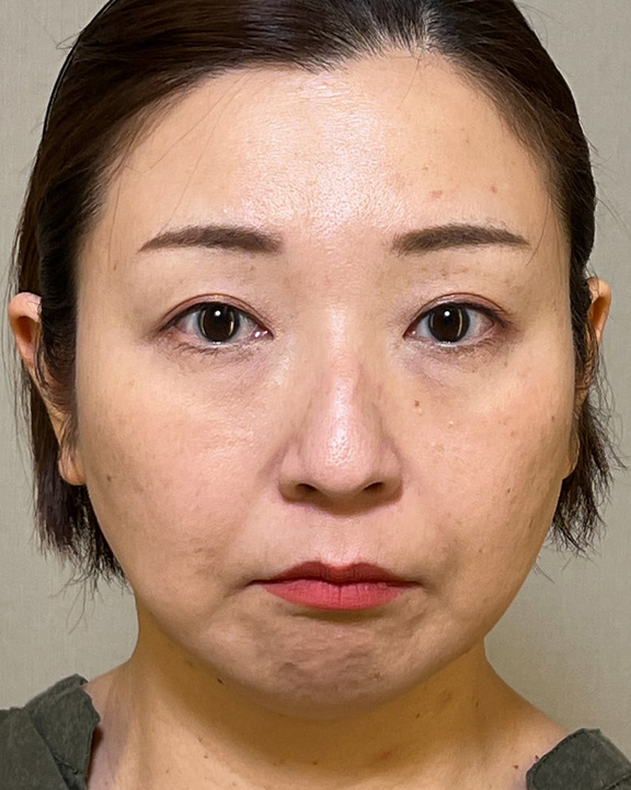 ミニフェイスリフトで口元のたるみを改善した女性の症例写真,Before,ba_minilift016_b01.jpg