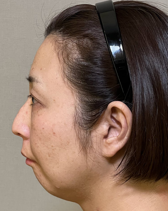 ミニフェイスリフト（頬のたるみ取り）,ミニフェイスリフトで口元のたるみを改善した女性の症例写真,Before,ba_minilift016_b02.jpg