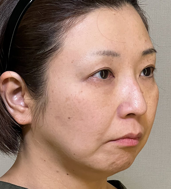 ミニフェイスリフト（頬のたるみ取り）,ミニフェイスリフトで口元のたるみを改善した女性の症例写真,Before,ba_minilift016_b03.jpg