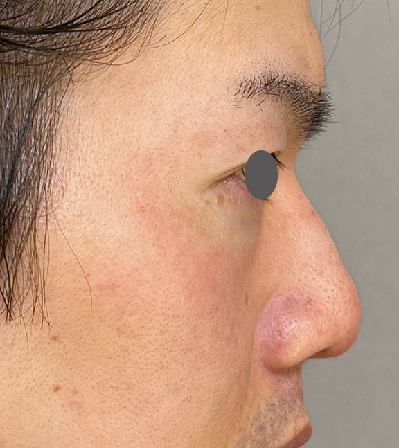 耳介軟骨移植（鼻先を出す）,耳介軟骨移植（クローズド法）で鼻を伸ばした症例写真,After（1ヶ月後）,ba_jikai049_a01.jpg