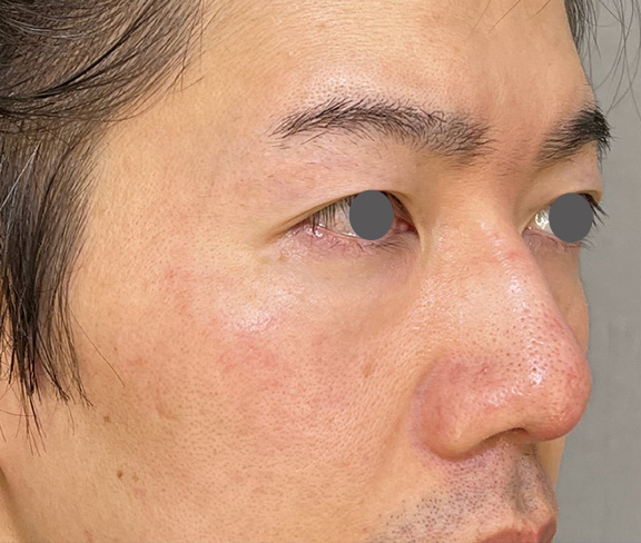 症例写真,耳介軟骨移植（クローズド法）で鼻を伸ばした症例写真,After（1ヶ月後）,ba_jikai049_b02.jpg