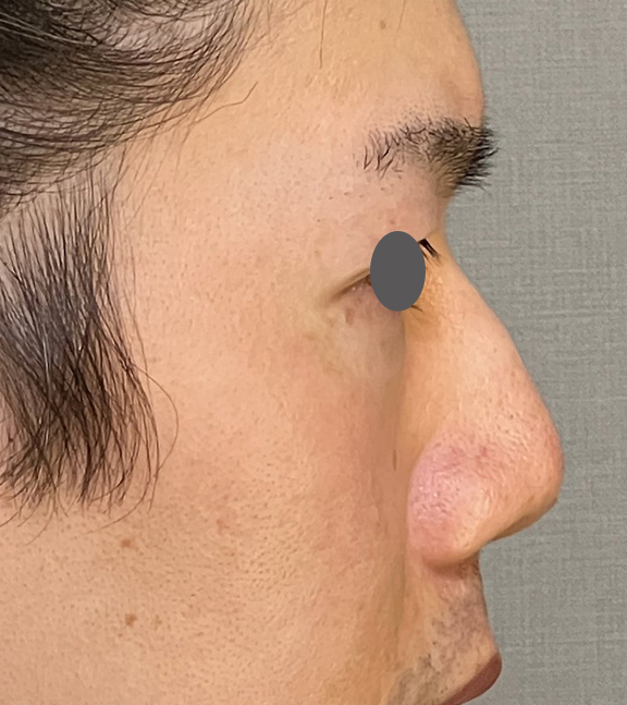 耳介軟骨移植（鼻先を出す）,耳介軟骨移植（クローズド法）で鼻を伸ばした症例写真,Before,ba_jikai049_b01.jpg