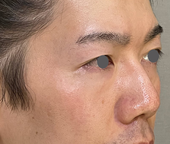 症例写真,耳介軟骨移植（クローズド法）で鼻を伸ばした症例写真,Before,ba_jikai049_b02.jpg