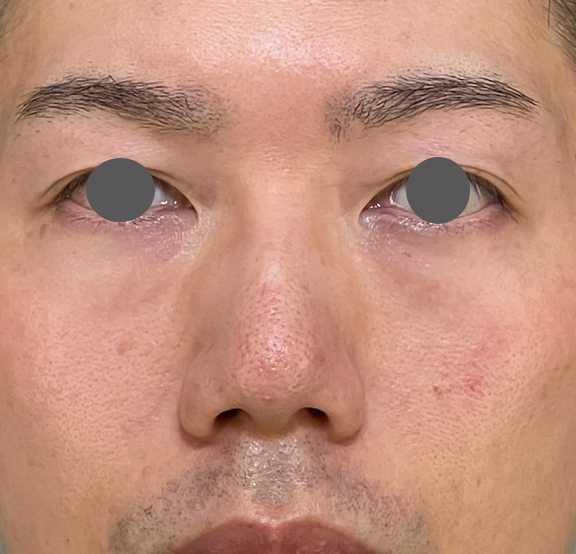 症例写真,耳介軟骨移植（クローズド法）で鼻を伸ばした症例写真,Before,ba_jikai049_b03.jpg