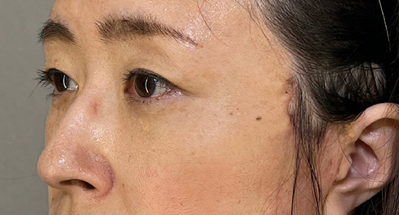 目の下のクマ治療,目の下の切らない脂肪取り＋眼窩脂肪移植の症例写真,After（1ヶ月後）（メイクあり）,ba_shibo_under002_b01.jpg