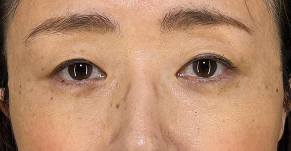 目の下のクマ治療,目の下の切らない脂肪取り＋眼窩脂肪移植の症例写真,After（1ヶ月後）（メイクあり）,ba_shibo_under002_b02.jpg