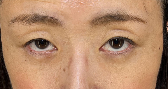 目の下の脂肪取り,目の下の切らない脂肪取り＋眼窩脂肪移植の症例写真,After（1ヶ月後）（メイクあり）,ba_shibo_under002_b03.jpg
