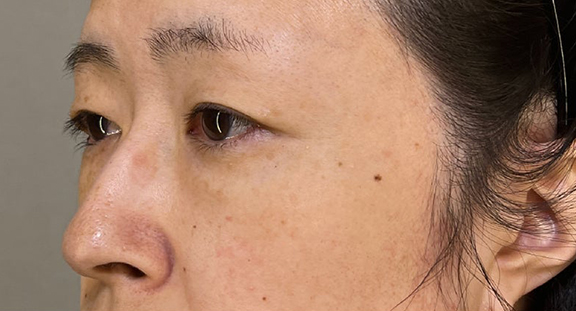 目の下のクマ治療,目の下の切らない脂肪取り＋眼窩脂肪移植の症例写真,Before,ba_shibo_under002_b01.jpg