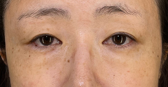 目の下の脂肪取り,目の下の切らない脂肪取り＋眼窩脂肪移植の症例写真,Before,ba_shibo_under002_b02.jpg