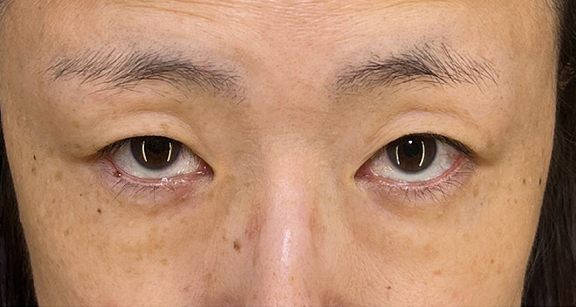 目の下の脂肪取り,目の下の切らない脂肪取り＋眼窩脂肪移植の症例写真,Before,ba_shibo_under002_b03.jpg