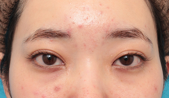 眼瞼下垂（がんけんかすい）,眼瞼下垂手術でツリ目を改善し、目を大きくした20代女性の症例写真,Before,ba_ganken045_b01.jpg