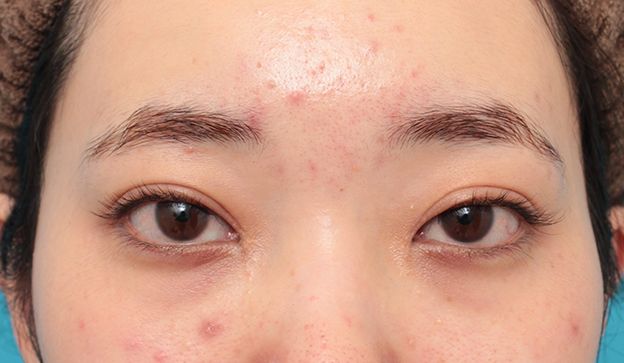 眼瞼下垂（がんけんかすい）,眼瞼下垂手術でツリ目を改善し、目を大きくした20代女性の症例写真,手術前,mainpic_ganken045a.jpg