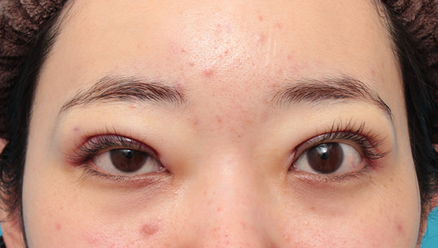 眼瞼下垂（がんけんかすい）,眼瞼下垂手術でツリ目を改善し、目を大きくした20代女性の症例写真,手術直後,mainpic_ganken045b.jpg