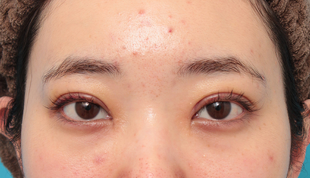 眼瞼下垂（がんけんかすい）,眼瞼下垂手術でツリ目を改善し、目を大きくした20代女性の症例写真,1週間後,mainpic_ganken045c.jpg