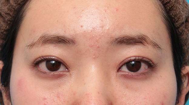 眼瞼下垂（がんけんかすい）,眼瞼下垂手術でツリ目を改善し、目を大きくした20代女性の症例写真,2ヶ月後,mainpic_ganken045e.jpg