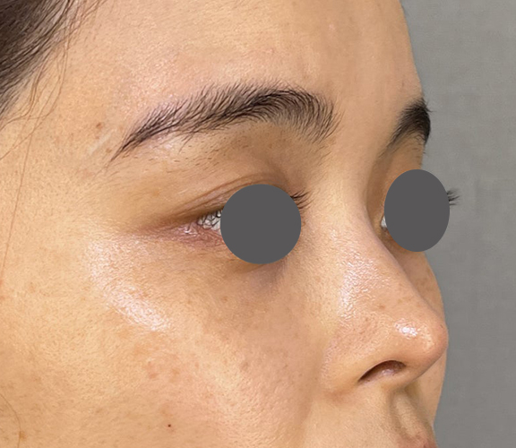 耳介軟骨移植（鼻先を出す）,耳介軟骨移植で鼻先をツンとさせた症例写真,After（3ヶ月後）,ba_jikai050_b02.jpg