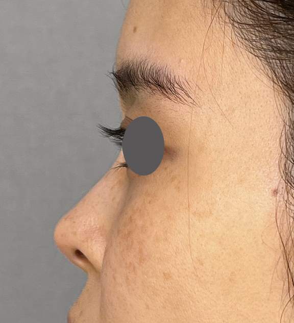 耳介軟骨移植（鼻先を出す）,耳介軟骨移植で鼻先をツンとさせた症例写真,After（3ヶ月後）,ba_jikai050_b03.jpg