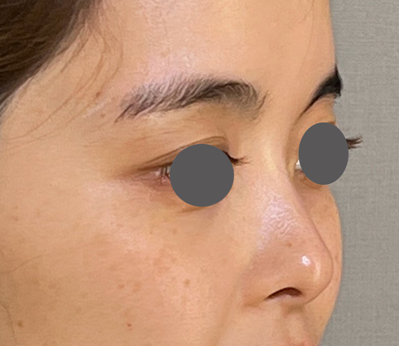 耳介軟骨移植（鼻先を出す）,耳介軟骨移植で鼻先をツンとさせた症例写真,Before,ba_jikai050_b02.jpg