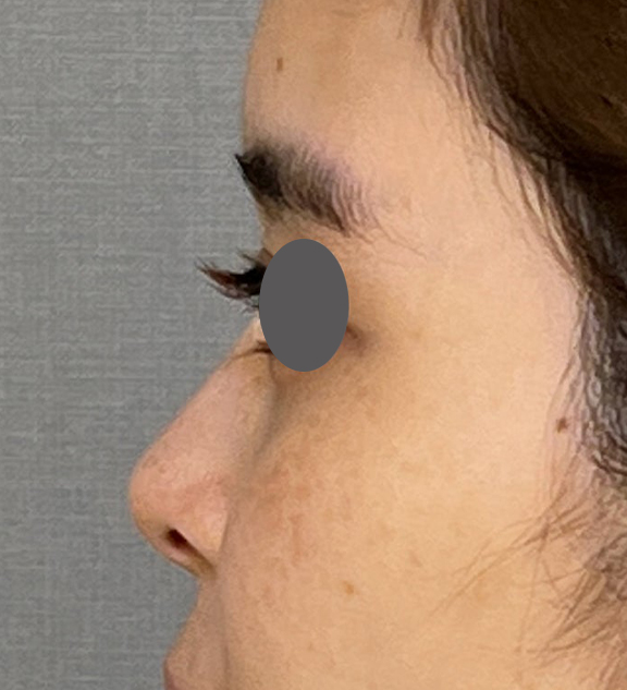 耳介軟骨移植（鼻先を出す）,耳介軟骨移植で鼻先をツンとさせた症例写真,Before,ba_jikai050_b03.jpg