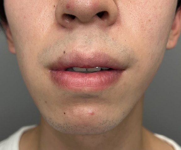 唇を薄く（口唇縮小術）,口唇縮小術で上下の唇を薄くした20代男性の症例写真,After（3ヶ月後）,ba_usuku020_b01.jpg