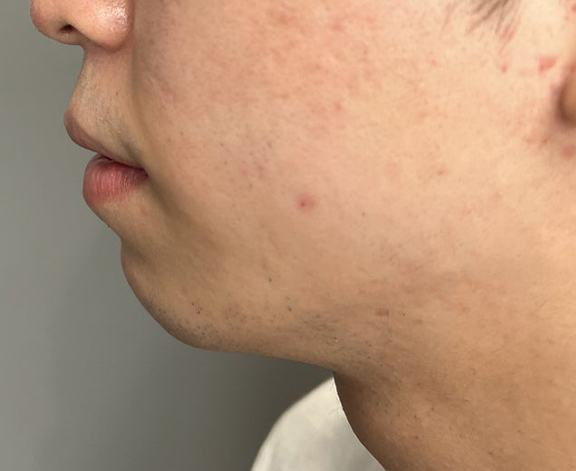 唇を薄く（口唇縮小術）,口唇縮小術で上下の唇を薄くした20代男性の症例写真,After（3ヶ月後）,ba_usuku020_b02.jpg