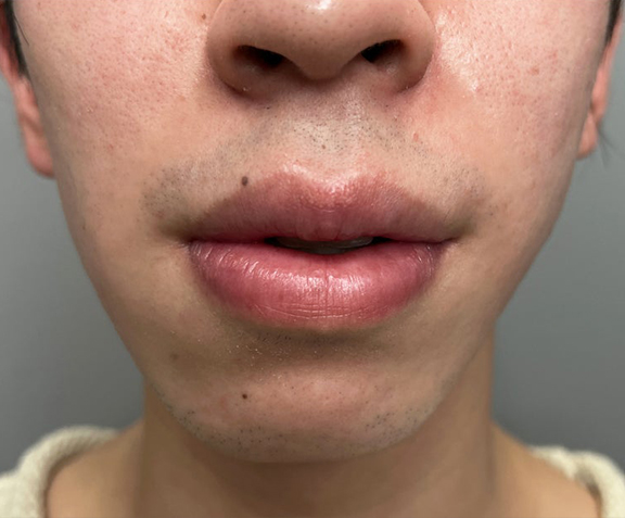 唇を薄く（口唇縮小術）,口唇縮小術で上下の唇を薄くした20代男性の症例写真,Before,ba_usuku020_b01.jpg
