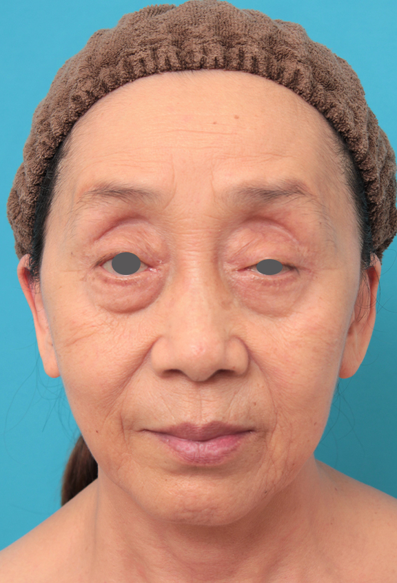 症例写真,ミディアムフェイスリフトを行った60代女性の症例写真,After（6ヶ月後）,ba_mediumlift023_b01.jpg