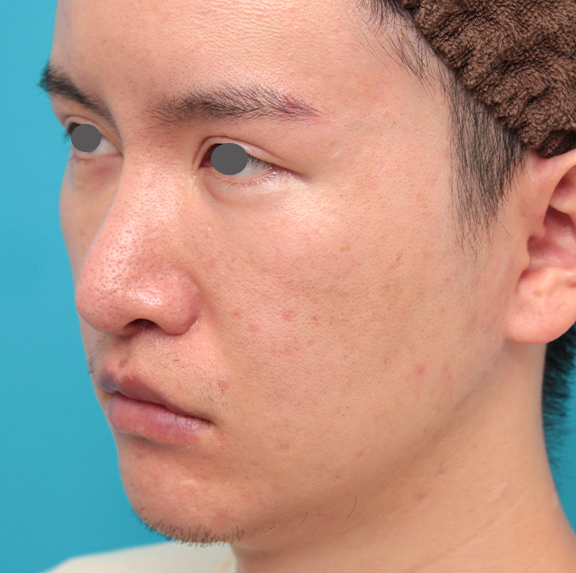 鼻の下を短く（上口唇短縮手術、上口唇リフト、リップリフト、人中短縮術）,人中短縮手術を行った20代男性の症例写真,After（2ヶ月後）,ba_hanashita012_b02.jpg