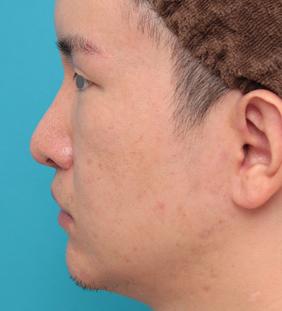 鼻の下を短く（上口唇短縮手術、上口唇リフト、リップリフト、人中短縮術）,人中短縮手術を行った20代男性の症例写真,After（2ヶ月後）,ba_hanashita012_b03.jpg