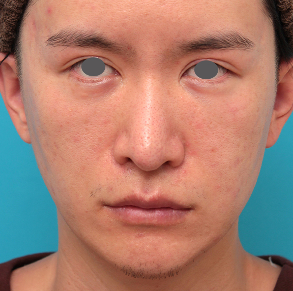 鼻の下を短く（上口唇短縮手術、上口唇リフト、リップリフト、人中短縮術）,人中短縮手術を行った20代男性の症例写真,Before,ba_hanashita012_b01.jpg