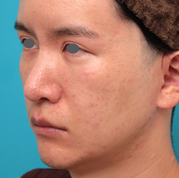鼻の下を短く（上口唇短縮手術、上口唇リフト、リップリフト、人中短縮術）,人中短縮手術を行った20代男性の症例写真,Before,ba_hanashita012_b02.jpg