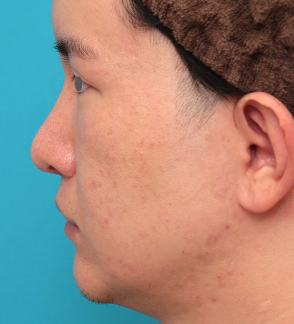 鼻の下を短く（上口唇短縮手術、上口唇リフト、リップリフト、人中短縮術）,人中短縮手術を行った20代男性の症例写真,Before,ba_hanashita012_b03.jpg