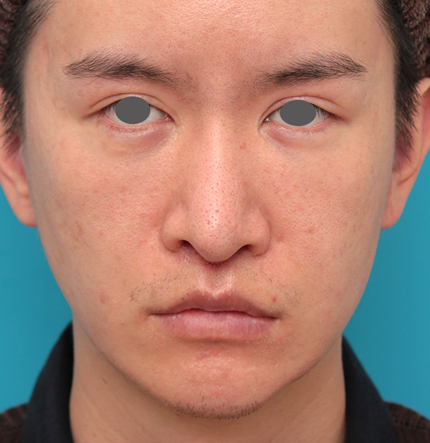 鼻の下を短く（上口唇短縮手術、上口唇リフト、リップリフト、人中短縮術）,人中短縮手術を行った20代男性の症例写真,1週間後,mainpic_hanashita012c.jpg