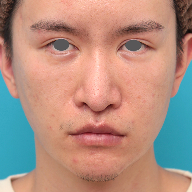 鼻の下を短く（上口唇短縮手術、上口唇リフト、リップリフト、人中短縮術）,人中短縮手術を行った20代男性の症例写真,2ヶ月後,mainpic_hanashita012d.jpg