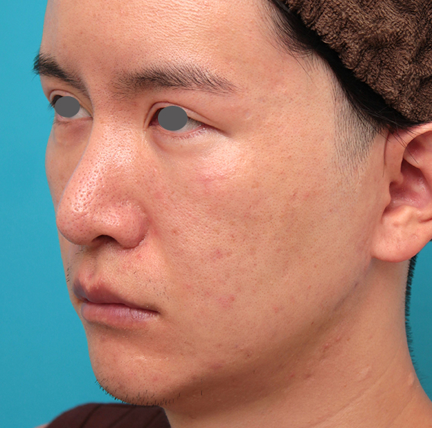 鼻の下を短く（上口唇短縮手術、上口唇リフト、リップリフト、人中短縮術）,人中短縮手術を行った20代男性の症例写真,手術前,mainpic_hanashita012e.jpg