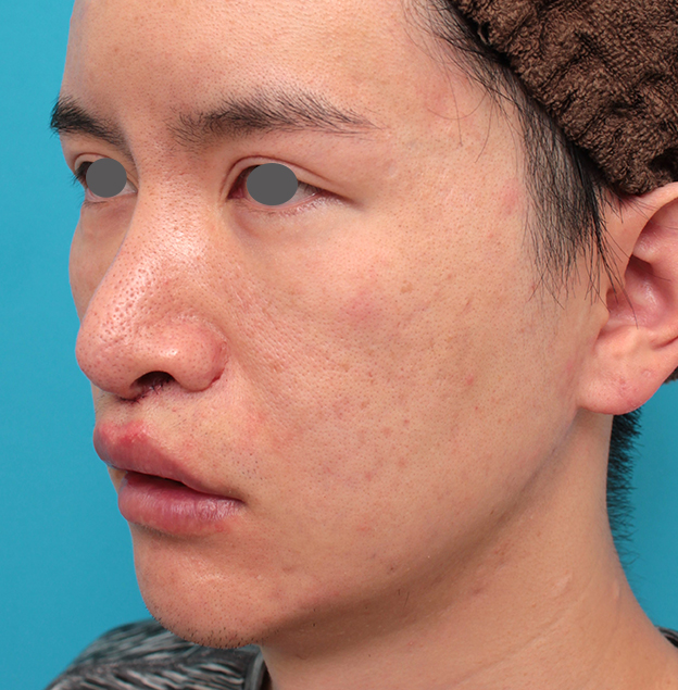 鼻の下を短く（上口唇短縮手術、上口唇リフト、リップリフト、人中短縮術）,人中短縮手術を行った20代男性の症例写真,手術直後,mainpic_hanashita012f.jpg