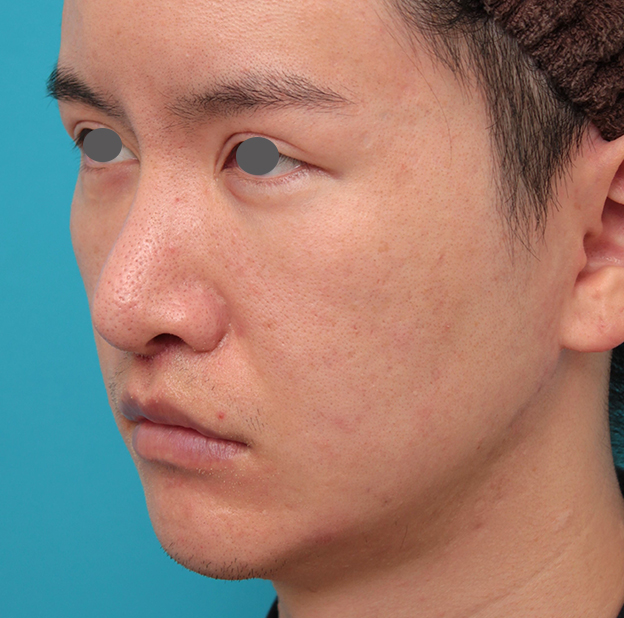 鼻の下を短く（上口唇短縮手術、上口唇リフト、リップリフト、人中短縮術）,人中短縮手術を行った20代男性の症例写真,1週間後,mainpic_hanashita012g.jpg