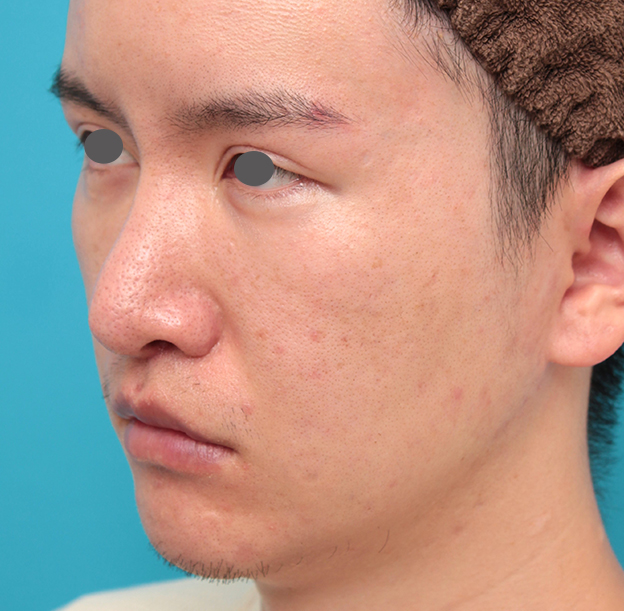 鼻の下を短く（上口唇短縮手術、上口唇リフト、リップリフト、人中短縮術）,人中短縮手術を行った20代男性の症例写真,2ヶ月後,mainpic_hanashita012h.jpg