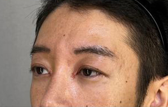 目頭切開,隆鼻注射（ヒアルロン酸注射）,プチ整形でハーフ顔に　ヒアルロン酸で彫りを深くした症例写真,After（1週間後）,ba_ryubi2044_a01.jpg