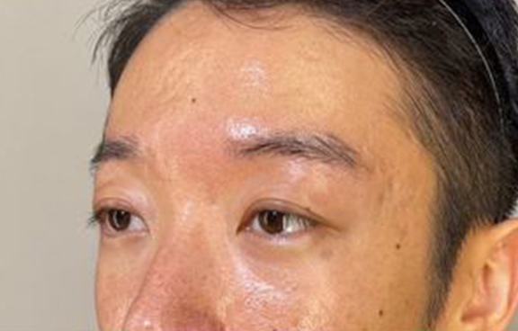 目頭切開,隆鼻注射（ヒアルロン酸注射）,プチ整形でハーフ顔に　ヒアルロン酸で彫りを深くした症例写真,Before,ba_ryubi2044_b01.jpg