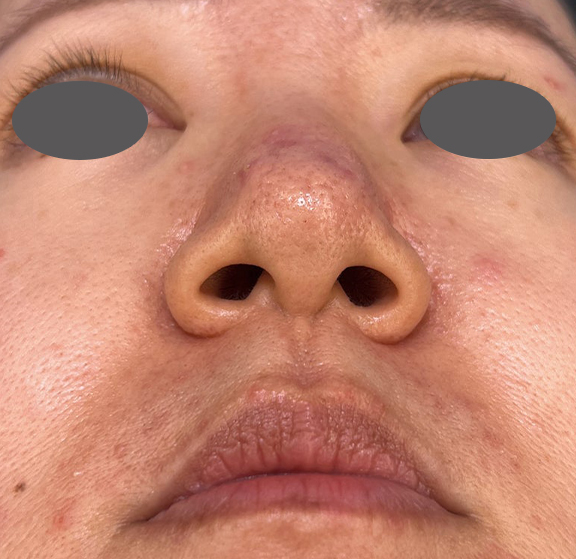 症例写真,外側法と内側法を組み合わせて施術した鼻翼縮小（小鼻縮小）の症例写真,Before,ba_biyoku055_b02.jpg