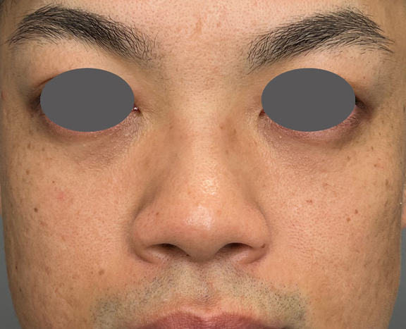 鼻施術として、鼻翼縮小（小鼻縮小）のみを行った症例写真,Before,ba_biyoku056_b01.jpg