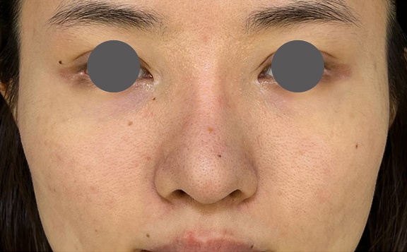 鼻を小さく細く見せるために隆鼻術（シリコンプロテーゼ）を行った症例写真,After（3ヶ月後）,ba_ryubi1064_a01.jpg