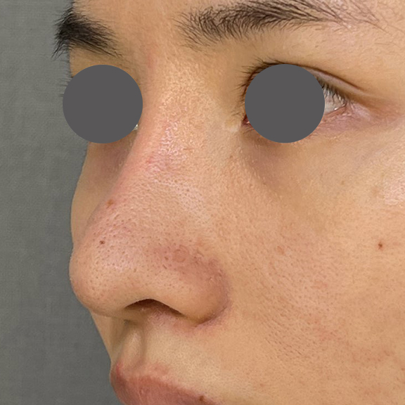 隆鼻術（シリコンプロテーゼ）,鼻を小さく細く見せるために隆鼻術（シリコンプロテーゼ）を行った症例写真,After（3ヶ月後）,ba_ryubi1064_b02.jpg