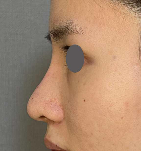 隆鼻術（シリコンプロテーゼ）,鼻を小さく細く見せるために隆鼻術（シリコンプロテーゼ）を行った症例写真,After（3ヶ月後）,ba_ryubi1064_b03.jpg